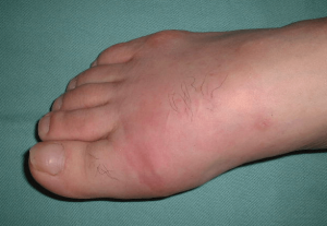 蜂窩織炎の症状の写真　足の腫れ 2